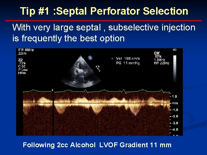 Tip #1 : Septal Perforator Selection With very large septal , subselective injection is