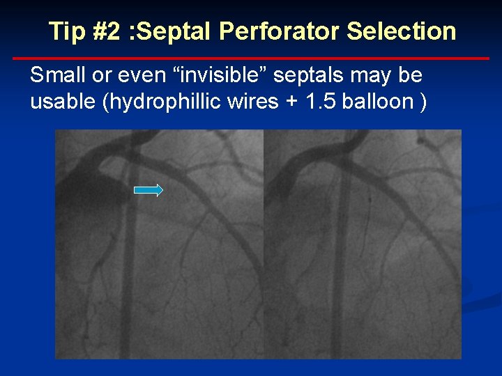 Tip #2 : Septal Perforator Selection Small or even “invisible” septals may be usable