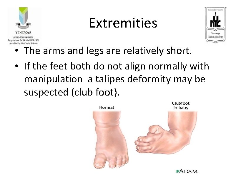Extremities • The arms and legs are relatively short. • If the feet both