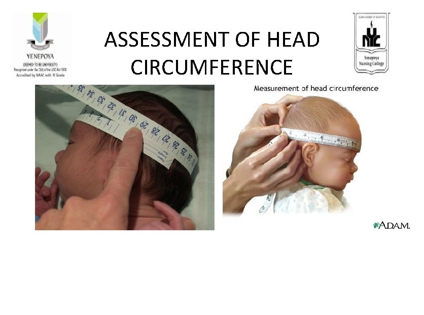 ASSESSMENT OF HEAD CIRCUMFERENCE 