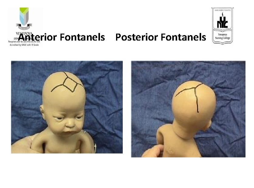  Anterior Fontanels Posterior Fontanels 