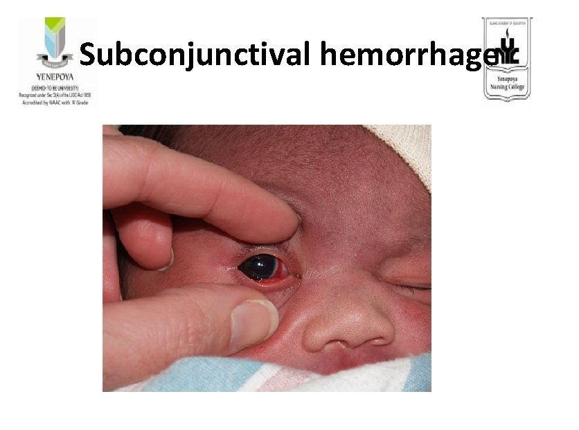 Subconjunctival hemorrhage 