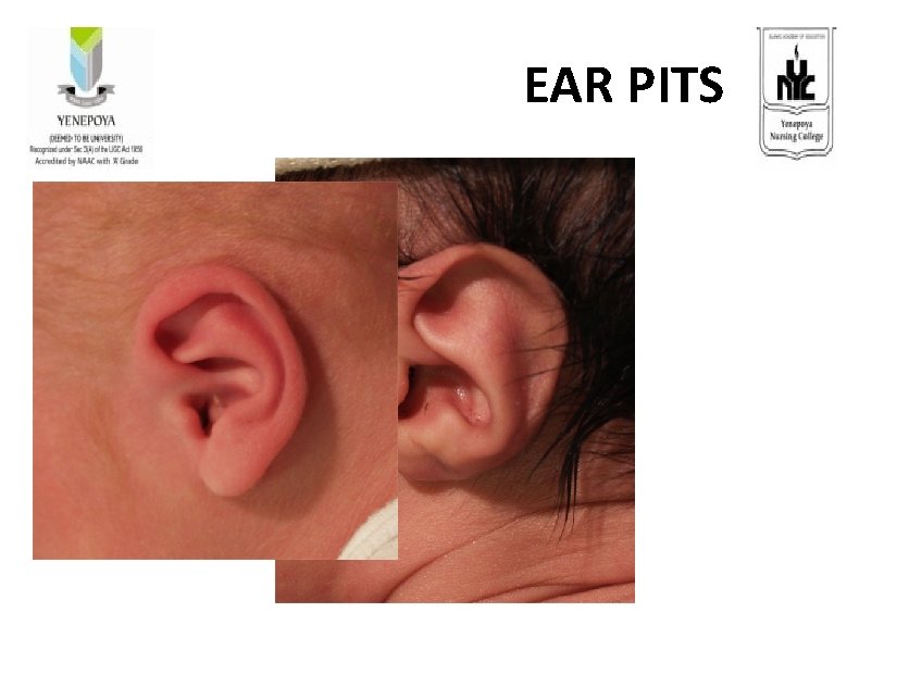  EAR PITS 