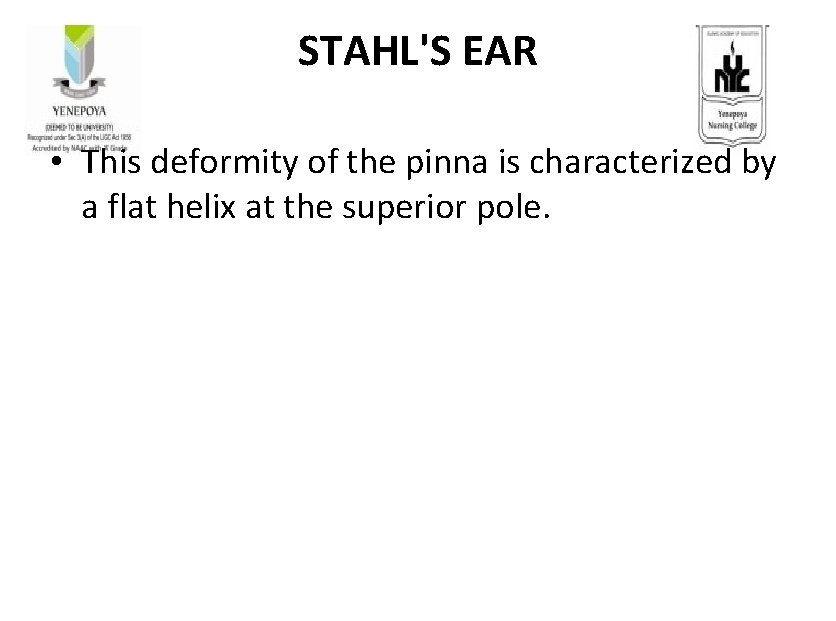 STAHL'S EAR • This deformity of the pinna is characterized by a flat helix