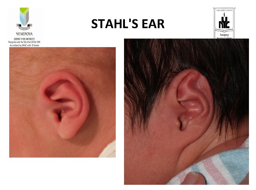 STAHL'S EAR 