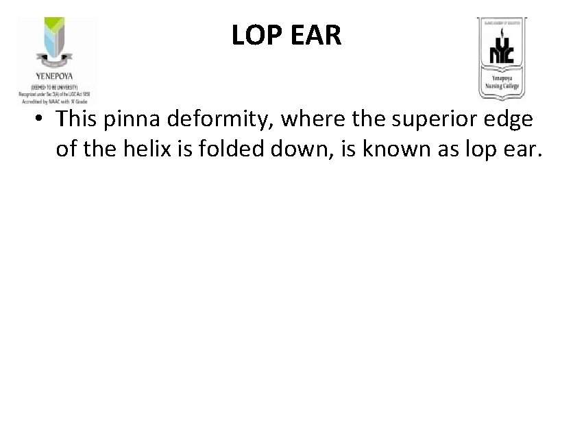 LOP EAR • This pinna deformity, where the superior edge of the helix is