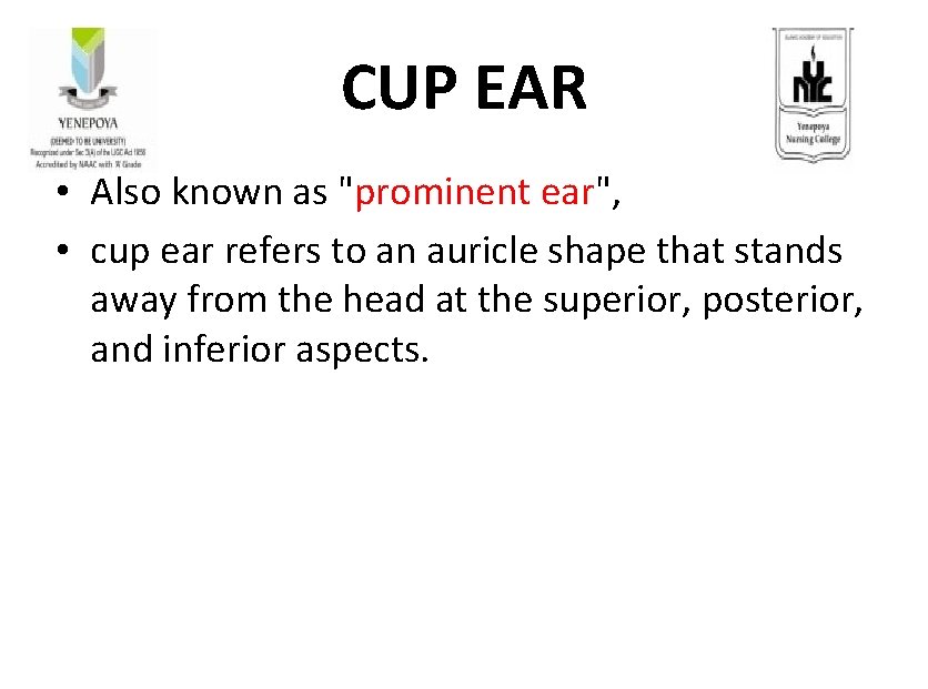 CUP EAR • Also known as "prominent ear", • cup ear refers to an