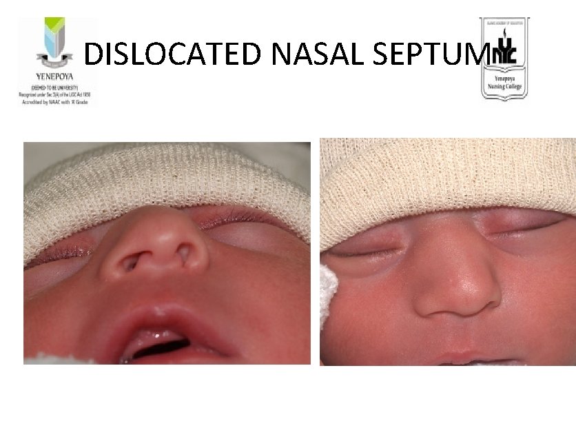 DISLOCATED NASAL SEPTUM 