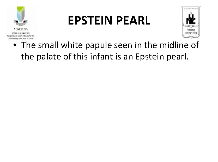 EPSTEIN PEARL • The small white papule seen in the midline of the palate