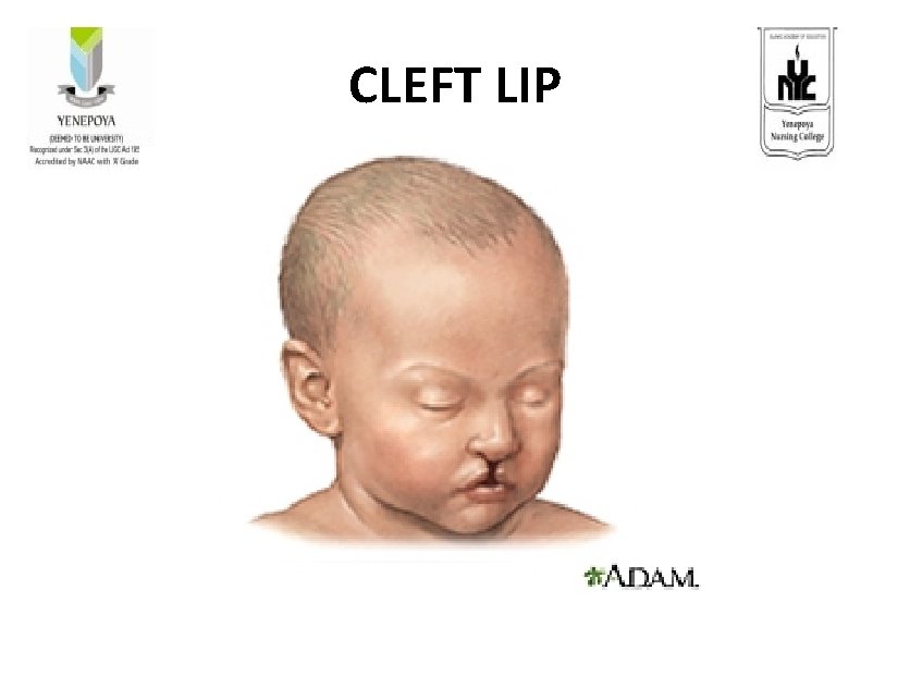 CLEFT LIP 