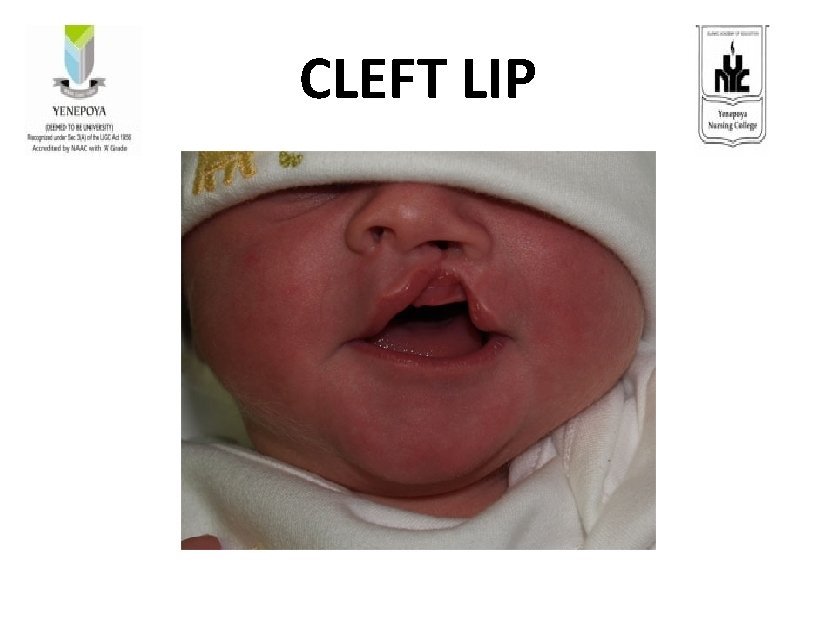 CLEFT LIP 