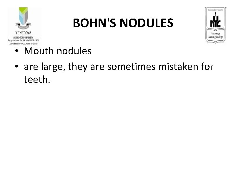 BOHN'S NODULES • Mouth nodules • are large, they are sometimes mistaken for teeth.