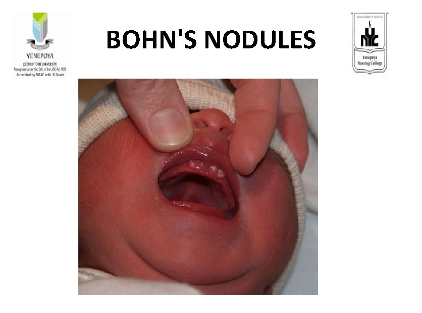 BOHN'S NODULES 