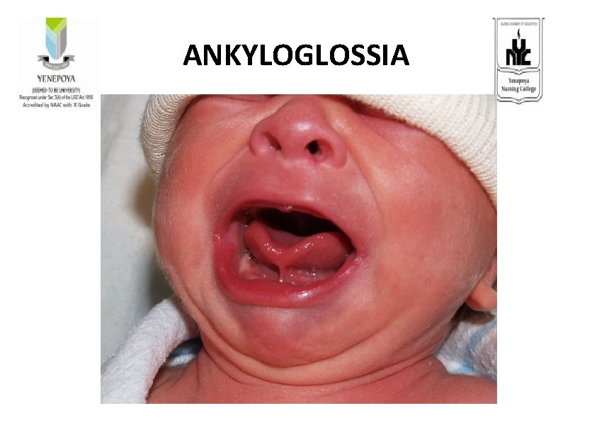 ANKYLOGLOSSIA 