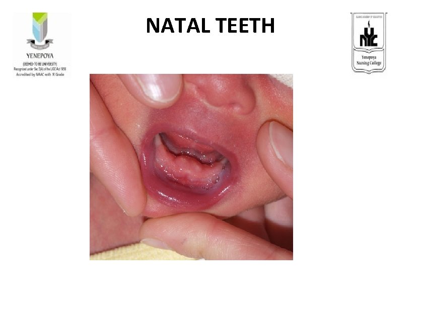 NATAL TEETH 
