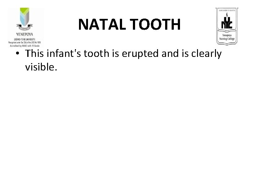 NATAL TOOTH • This infant's tooth is erupted and is clearly visible. 