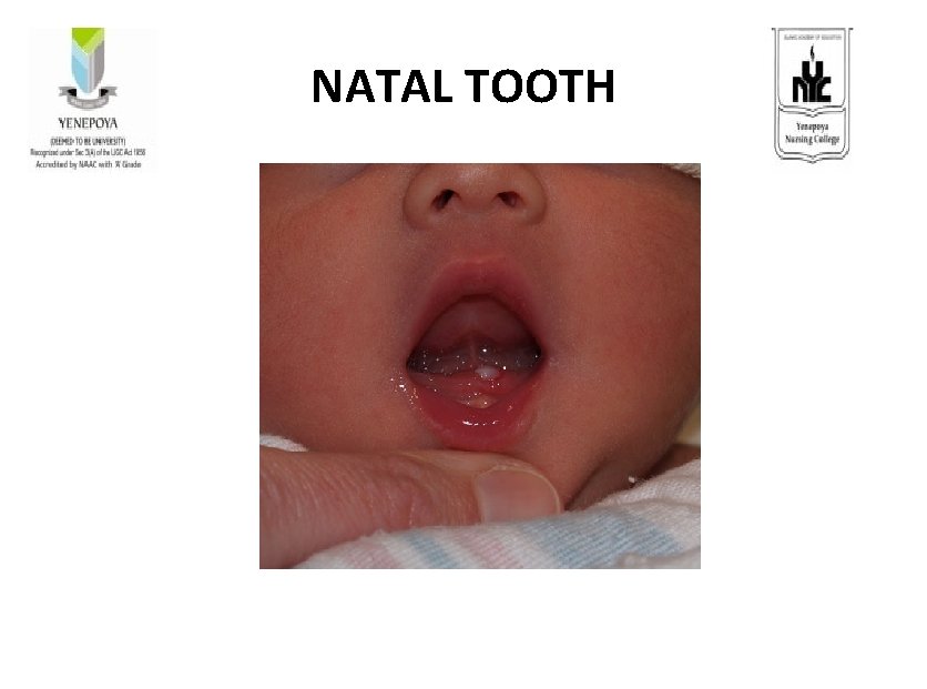 NATAL TOOTH 