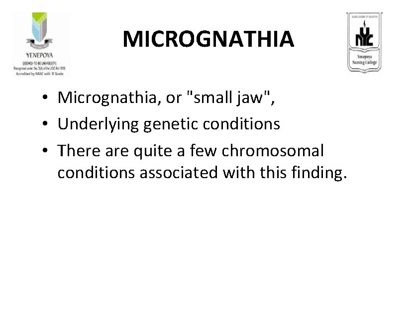 MICROGNATHIA • Micrognathia, or "small jaw", • Underlying genetic conditions • There are quite