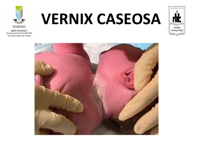 VERNIX CASEOSA 