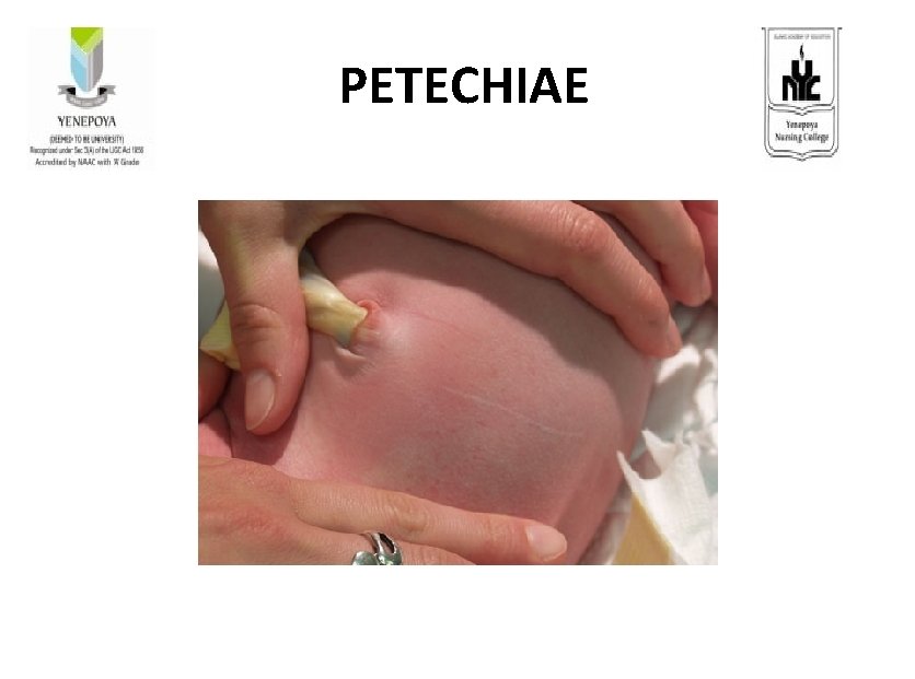  PETECHIAE 