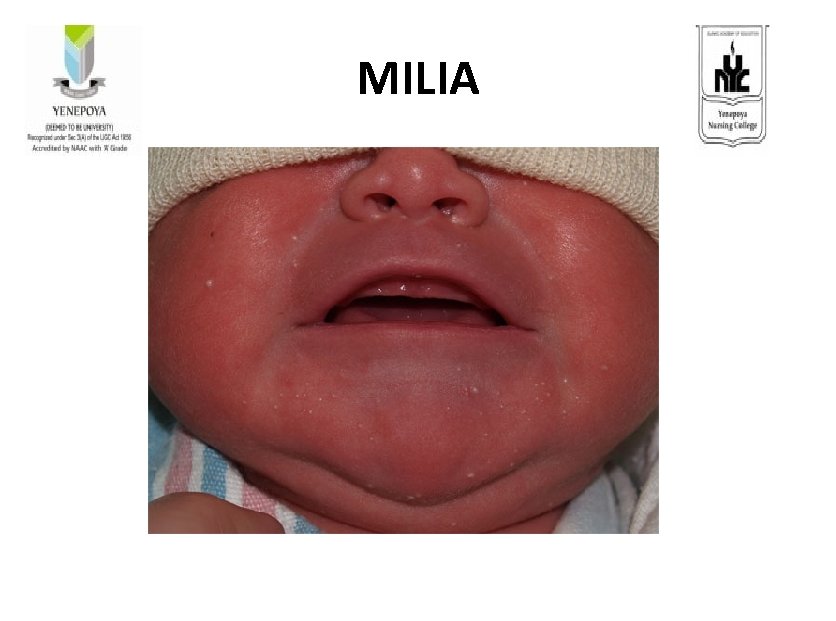 MILIA 