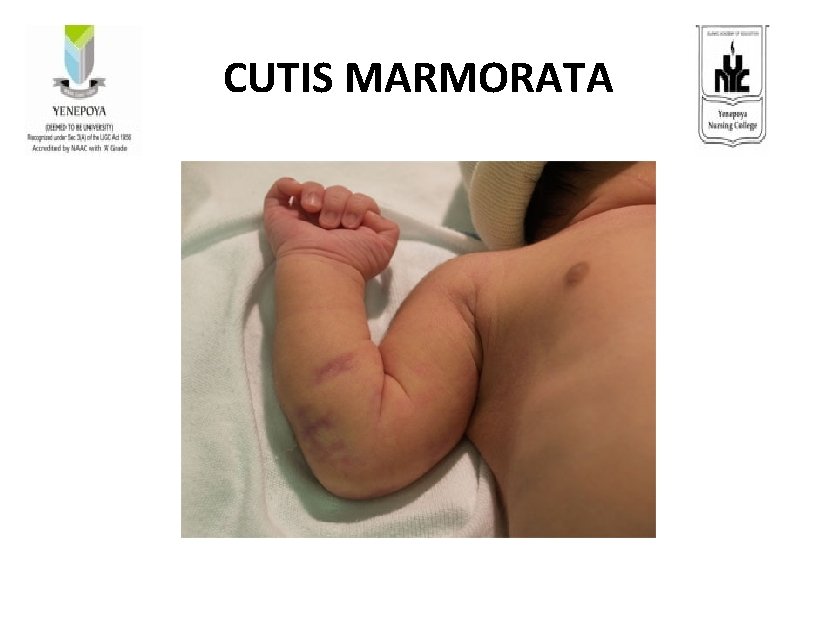 CUTIS MARMORATA 