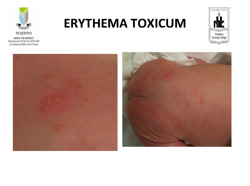 ERYTHEMA TOXICUM 