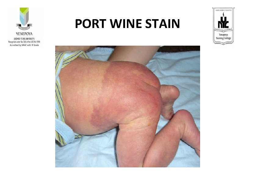 PORT WINE STAIN 