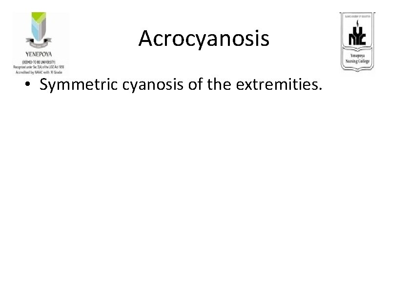 Acrocyanosis • Symmetric cyanosis of the extremities. 