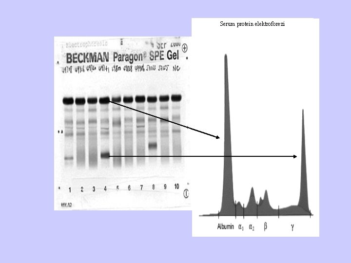 Serum protein elektroforezi 