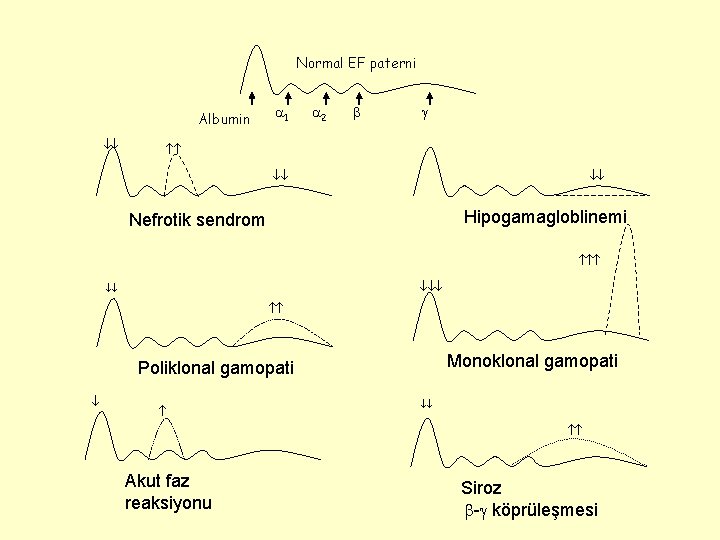 Normal EF paterni Albumin 1 2 Hipogamagloblinemi Nefrotik sendrom Monoklonal gamopati Poliklonal gamopati Akut