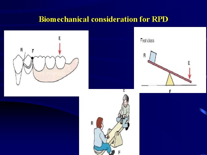 Biomechanical consideration for RPD 
