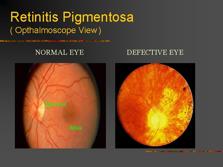 Retinitis Pigmentosa ( Opthalmoscope View ) NORMAL EYE DEFECTIVE EYE 