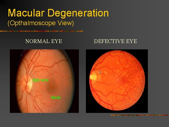 Macular Degeneration (Opthalmoscope View) NORMAL EYE DEFECTIVE EYE 