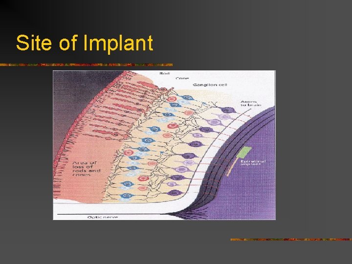 Site of Implant 