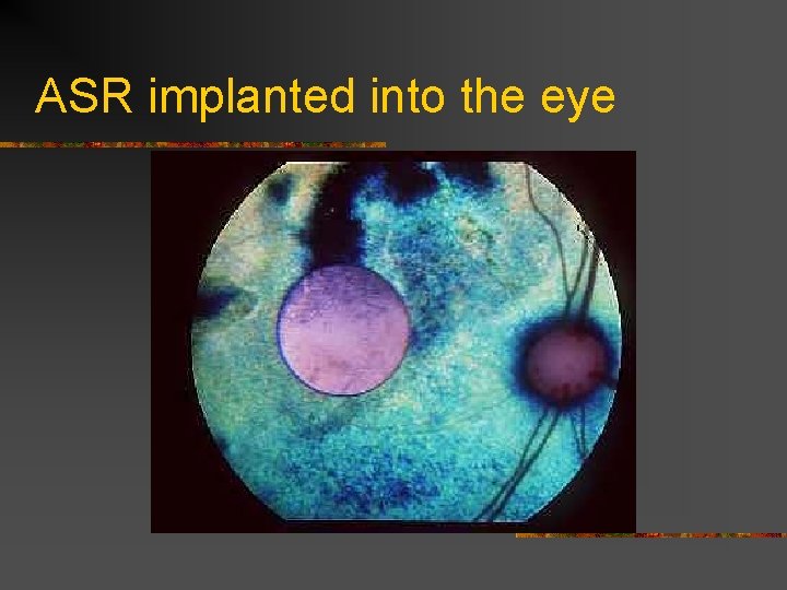 ASR implanted into the eye 