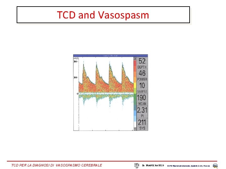 TCD and Vasospasm 250 200 0 TCD PER LA DIAGNOSI DI VASOSPASMO CEREBRALE Dr.
