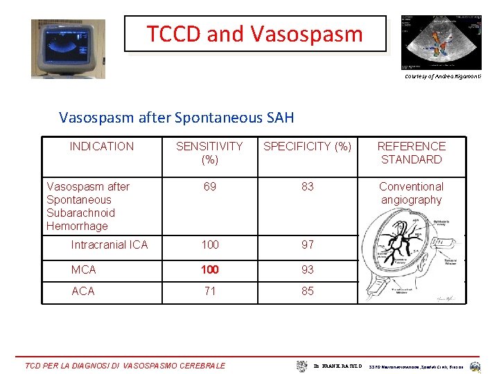 TCCD and Vasospasm Courtesy of Andrea Rigamonti Vasospasm after Spontaneous SAH INDICATION SENSITIVITY (%)