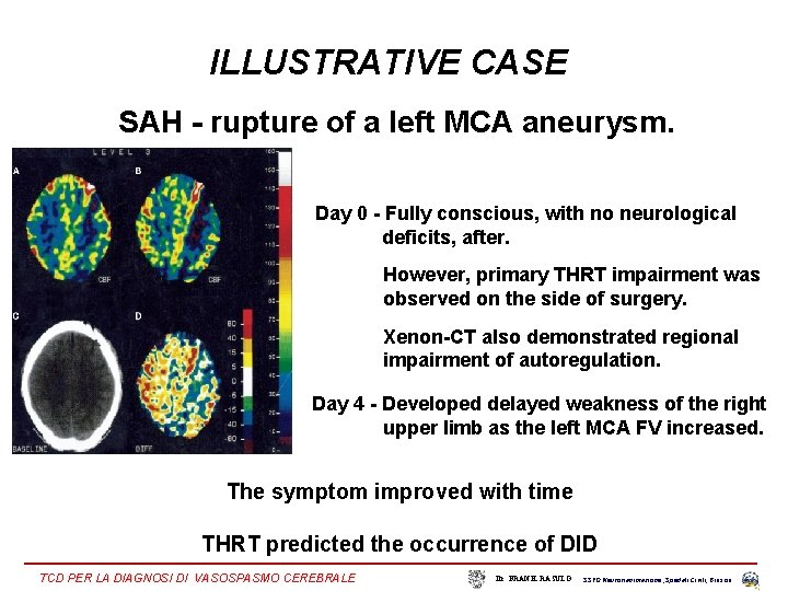 ILLUSTRATIVE CASE SAH - rupture of a left MCA aneurysm. Day 0 - Fully