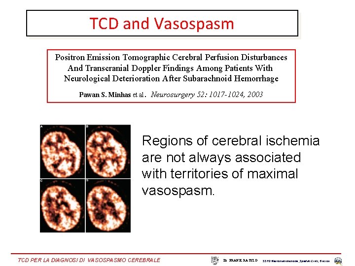 TCD and Vasospasm Positron Emission Tomographic Cerebral Perfusion Disturbances And Transcranial Doppler Findings Among