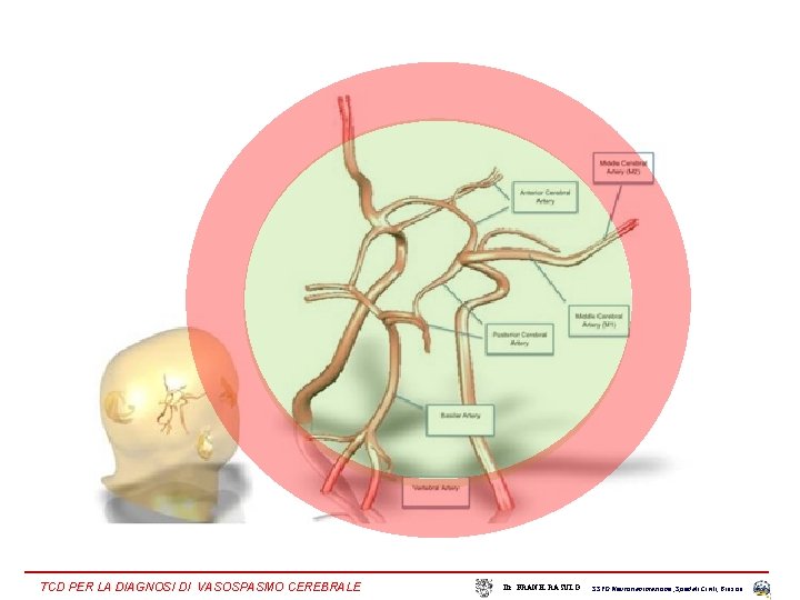 TCD PER LA DIAGNOSI DI VASOSPASMO CEREBRALE Dr. FRANK RASULO SSVD Neurorianimazione , Spedali