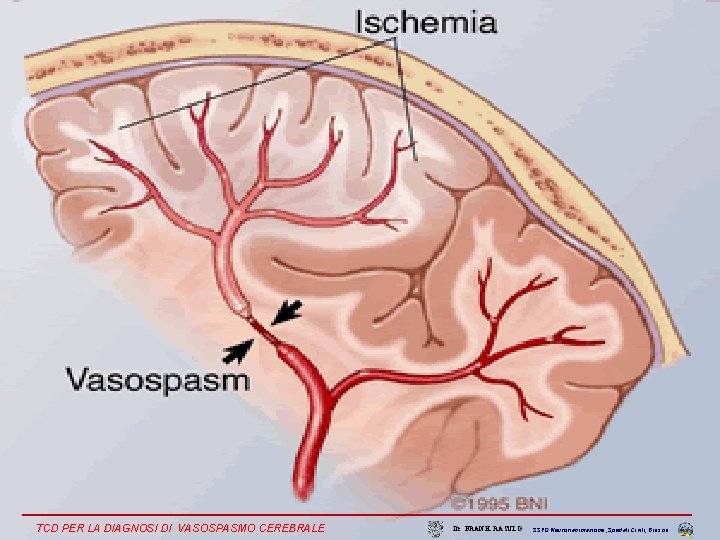 TCD PER LA DIAGNOSI DI VASOSPASMO CEREBRALE Dr. FRANK RASULO SSVD Neurorianimazione , Spedali