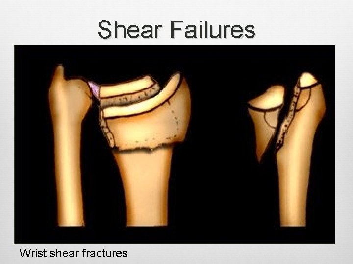 Shear Failures Wrist shear fractures 