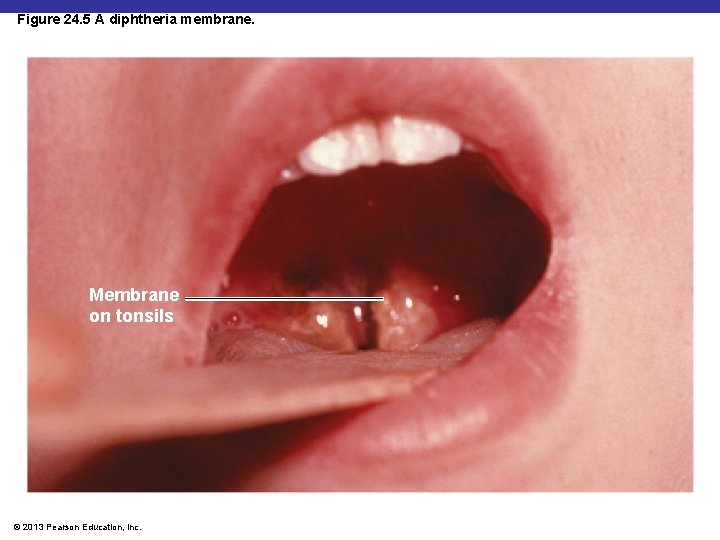 Figure 24. 5 A diphtheria membrane. Membrane on tonsils © 2013 Pearson Education, Inc.