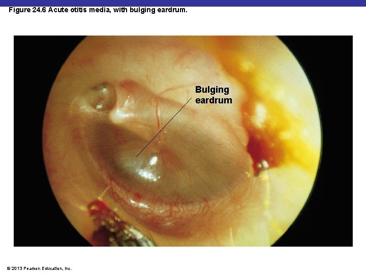 Figure 24. 6 Acute otitis media, with bulging eardrum. Bulging eardrum © 2013 Pearson
