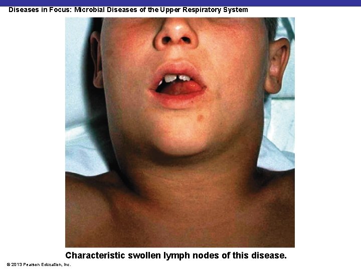 Diseases in Focus: Microbial Diseases of the Upper Respiratory System Characteristic swollen lymph nodes