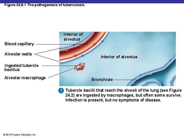Figure 24. 9. 1 The pathogenesis of tuberculosis. Blood capillary Alveolar walls Interior of