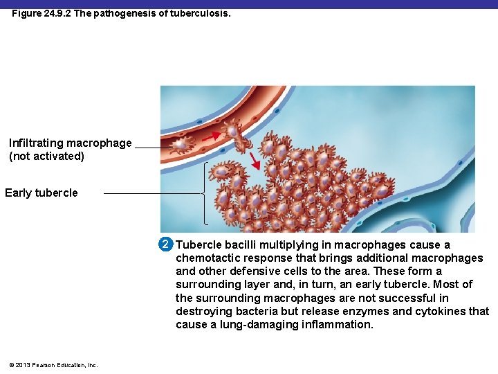 Figure 24. 9. 2 The pathogenesis of tuberculosis. Infiltrating macrophage (not activated) Early tubercle