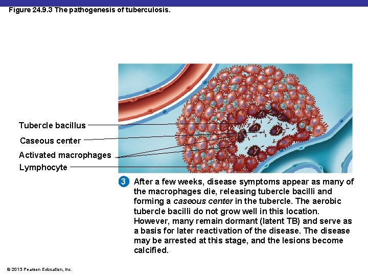 Figure 24. 9. 3 The pathogenesis of tuberculosis. Tubercle bacillus Caseous center Activated macrophages