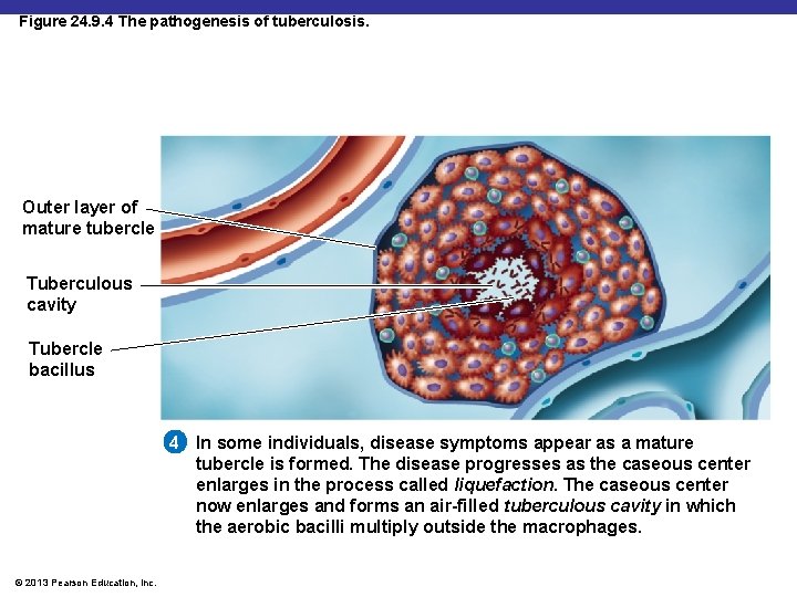 Figure 24. 9. 4 The pathogenesis of tuberculosis. Outer layer of mature tubercle Tuberculous
